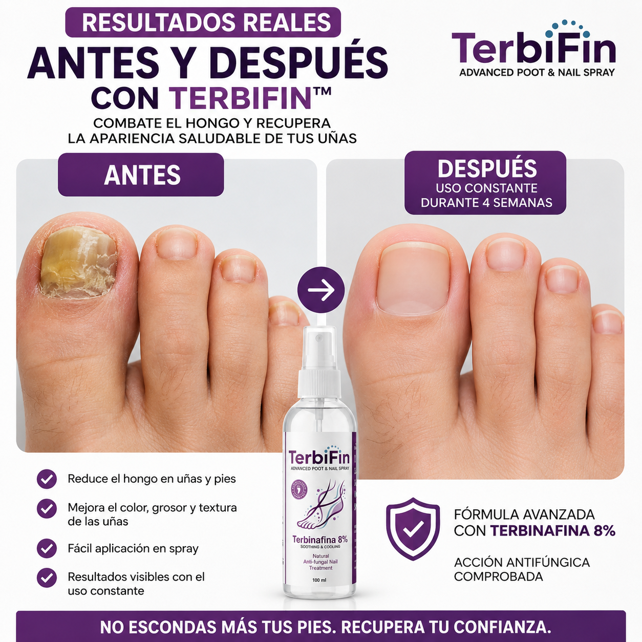 TerbiFin™ Spray Antihongos para Pies y Uñas – ¡2x1 Oferta Especial!
