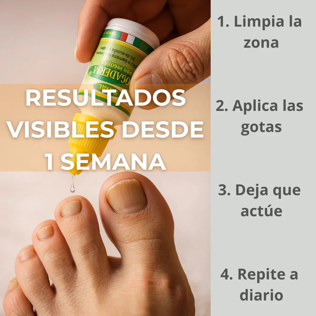 💧 Nogaderm – Gotas Antihongos con Resultados en 7 Días