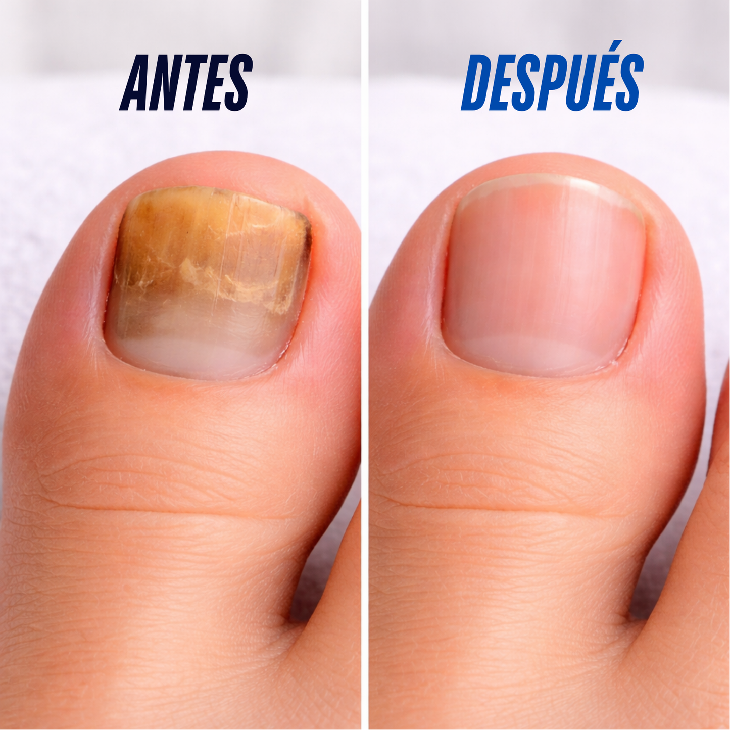 Parches eliminadores de hongos PROMO 2x1 – ¡Recupera la salud de tus uñas mientras duermes!